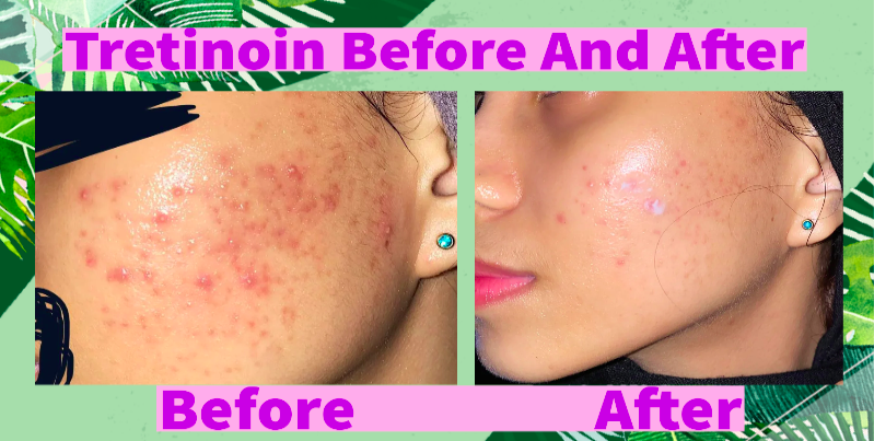 A Redditor Journey to Clear Skin Using Tretinoin and Panoxyl Unite